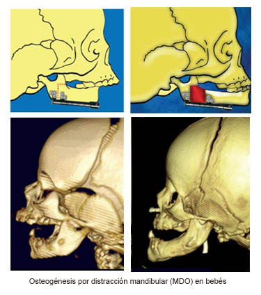 https://kiddievaultboxes.store/SiteCollectionImages/Infant_Mandibular_Distraction_Osteogenesis_es.jpg
