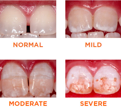 Dental fluorosis is a change in the appearance of the tooth's enamel surface. The most common types do not affect the function of the tooth and don't cause pain.