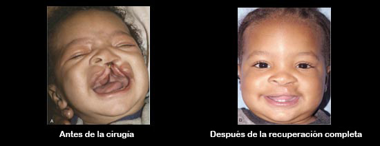 https://kiddievaultboxes.store/SiteCollectionImagesArticleImages/CleftbeforeAfter_Baby_es.jpg
