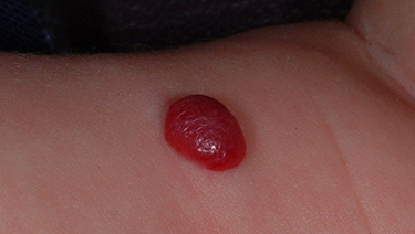Baby with birthmark.