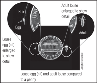 Head Lice - Image