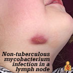 The most common infections of the neck are viral or bacterial and some can be treated with