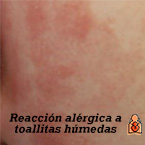 En ocasiones, los bebés con piel muy sensible pueden presentar una