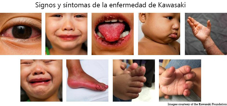 https://kiddievaultboxes.store/SiteCollectionImagesArticleImages/Signs_Symptoms_Kawasaki_Disease_es.jpg