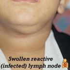 Lymph nodes are part of the immune system and help rid the body of harmful bacteria, viruses, and other causes of irritation or infection. There are 200 to 300 lymph nodes in the back of the nose, throat, and neck. They may swell when you child's body is fighting a