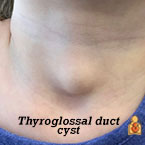Thyroglossal duct cysts