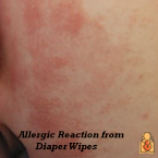 Occasionally, babies with sensitive skin may have an