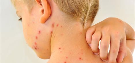 chicken pox boy