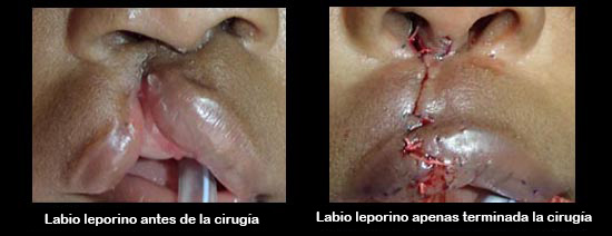 https://kiddievaultboxes.store/SiteCollectionImagesArticleImages/cleftLipBeforeAfter2_es.jpg