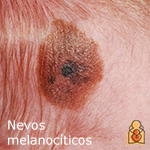 Nevos melanocíticos