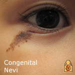 Congenital Nevi - HealthyChildren.org