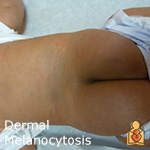 Dermal Melanocytosis - HealthyChildren.org