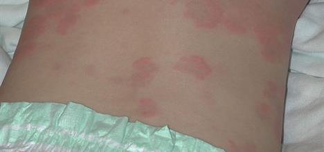 Hives