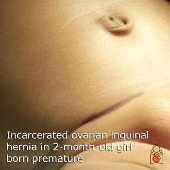 Inguinal Hernia in Infants & Children - HealthyChildren.org
