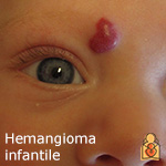 Hemangioma infatile