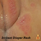 The diaper area spends much of the day in contact with two very irritating substances: urine and stool. If your child has