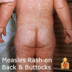 Protecting Your Baby from a Measles Outbreak FAQs