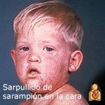Imagen del sarpullido de sarampión en la cara.