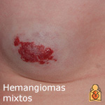 Hemangiomas mixtos