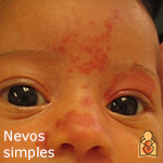 Nevos simples