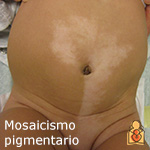 Mosaicismo pigmentario
