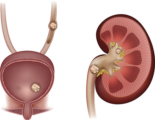 Stones can form in a child's kidney without causing symptoms for a long time. However, if a stone starts to move down the urinary tract through the tube called the ureter, it can cause symptoms such as: