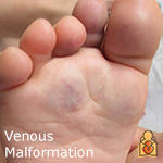 Venous Malformation - HealthyChildren.org