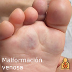 Malformación venosa