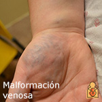Malformación venosa