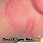 Another fairly common cause of diaper rash is yeast infection, caused by overgrowth of a type of fungus found naturally in the digestive tract. Clues that the rash might be due to a yeast infection include shiny, bright red or pink patches with sharp edges. This rash may also have little pink bumps or pimples. In severe cases, there may be sores or cracking skin that oozes or bleeds. Unlike with irritant diaper rash, a yeast diaper rash is usually worse in the groin folds.